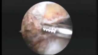 RL L shldr subpectoral biceps tenodesis subacromial decompression mumford 4215 [upl. by Asereht]