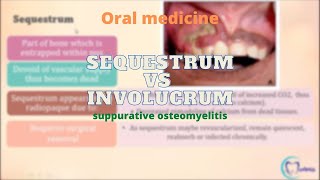 Sequestrum Vs Involucrum  Osteomyelitis  Oral Medicine  Dentophile [upl. by Dusty]