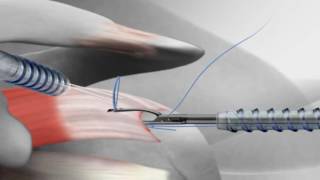 Rotator Cuff Repair with Arthrex® SutureBridge™ [upl. by Sylado]