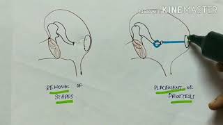 otosclerosis  ENT  etiology  pathophysiology  clinical manifestations  treatment  English [upl. by Eetnahc89]