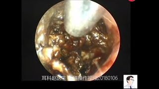 Earwax Removal ExtractionThe first case of giant external auditory meatus cholesteatoma in 2018 [upl. by Gabbie]