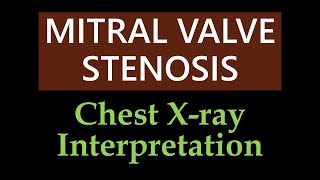 Mitral Valve Stenosis  Chest Xray Interpretation [upl. by Jaddan]