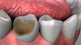 Crowns Core Build Up Procedure [upl. by Eimat]