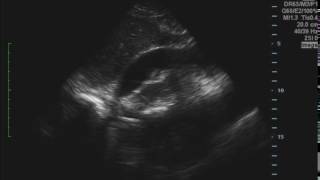 Cardiac Tamponade Ultrasound JETem 2016 [upl. by Esoj]