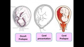 Cord prolapse amp Cord presentation [upl. by Vashti885]