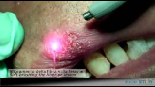 Doctor Smile Dental Laser  Canker sores Diode Laser Therapy [upl. by Neelac]