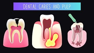 Dental caries and pulp [upl. by Toiboid]