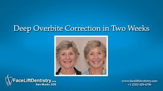 Deep Overbite Correction in Two Weeks [upl. by Binah]