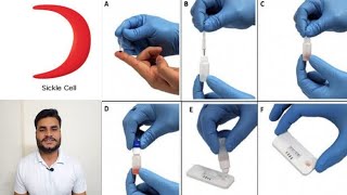 Sickle cell anemia  causessymptoms diagnosis test procedure treatment amp pathology sicklecell [upl. by Conny]