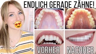 VORHERNACHHER SO sehen meine Zähne JETZT aus Meine Erfahrung mit Invisalign TheBeauty2go [upl. by Aokek]