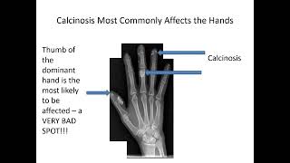 Calcinosis in Scleroderma Carrie Richardson MD MHS [upl. by Lav2]