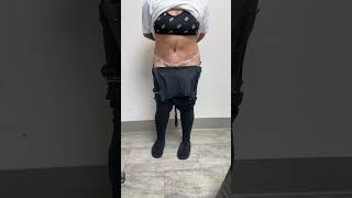 1 DAY AFTER A TUMMY TUCK BY DR GABRIEL PATINO 05 09 20245105257999 [upl. by Ursulette915]