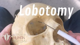 The Anatomy of a Lobotomy [upl. by Albert]