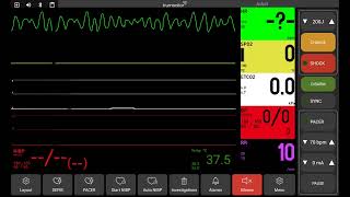 Ventricular fibrillation [upl. by Matheson]