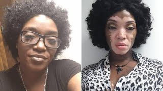 Woman Embraces Her Vitiligo After 30 Years of Hiding Under Makeup [upl. by Adimra]