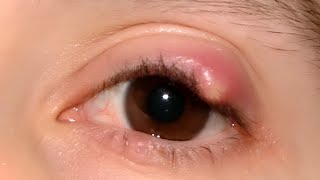 Chalazion Cyst [upl. by Akel877]