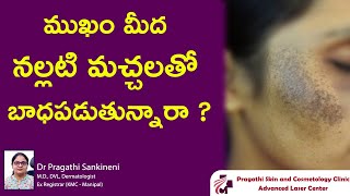 ముఖం మీద నల్లటి మచ్చలతో బాధపడుతున్నారా  facial melanosis  Dr Pragathi  Dermatologist  Nizamabad [upl. by Popele]