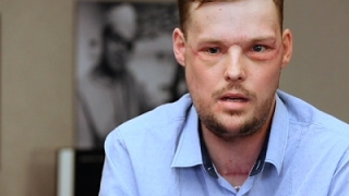 Face Transplant Links Men Touched by Tragedy [upl. by Asinla586]