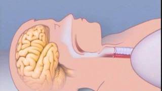 What Is Sleep Apnea [upl. by Noreht]