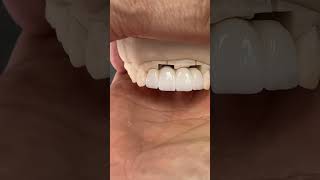 The journey to restoring Anterior Teeth lsk121shorts teeth dental EnvisiontecMain envisiontec [upl. by Aillij138]