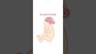 Types of Neural Tube Defects Anencephaly and Encephalocele [upl. by Kcirted]