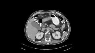 Scirrhous gastric adenocarcinoma signet ring cell type [upl. by Asseneg175]