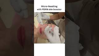 Micro Needling with PDRN skin booster [upl. by Migeon]