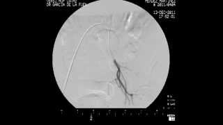 Arteriografía Renal [upl. by Dressler]