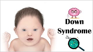 Down Syndrome  Signs amp Symptoms Clinical Features And LongTerm Complications [upl. by Paulie]