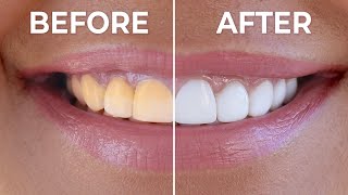 Instant Teeth Whitening At Home  How To Naturally Whiten Yellow Teeth [upl. by Yahsal]