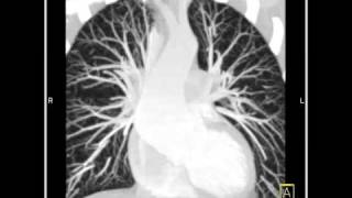 VascularAscending aorta3D and 4D mapping demonstrating a dilated ascending aorta7 of 10 [upl. by Eustache132]