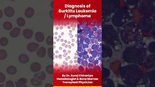 Diagnosis of Burkitts Leukemia or Lymphoma burkitt leukemia lymphocytes lymphoma bloodcancer [upl. by Acnoib]