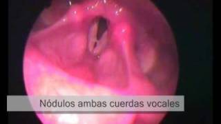 Lesiones en cuerdas vocales y laringe [upl. by Cale]