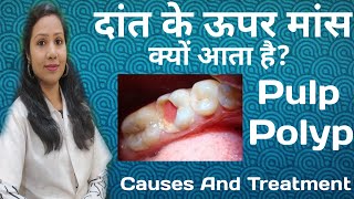 दांत के ऊपर मास क्यों आता हैक्या करें Pulp polyp Causes And Treatment Of Pulp Polyp [upl. by Eednam]