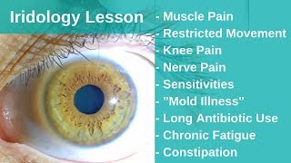 Iridology  The Key to Solving Chronic Pain Through Detoxification [upl. by Glenn162]