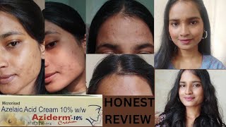 Azelaic Acid Cream 10  Aziderm Cream  Honest Review  Remove Pigmentation  Acne  Dark Sports [upl. by Karolyn499]