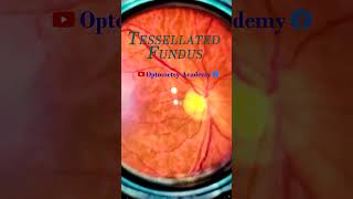 Tessellated Fundus  Indirect Ophthalmoscopy  Smartphone Fundus Videography  Short Video 58 [upl. by Johnna]