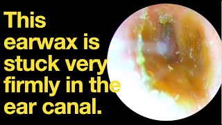 This earwax is stuck very firmly in the ear canalear wax removal  ear cleaning  ASMR relax [upl. by Hebrew]