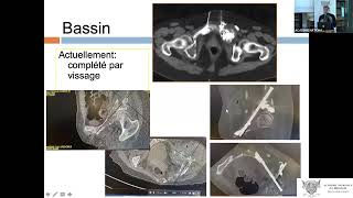 Radiologie interventionelle et métastases osseuses quelles options en 2023 [upl. by Aronson]