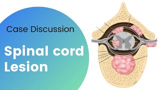 Case Discussion  Spinal Cord Lesion [upl. by Adnamra]