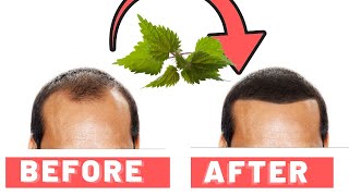 Stinging Nettle Root For Hair Loss How It Works [upl. by Christal]