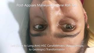 Transformation of Apogeotropic Horizontal Canal BPPV to Geotropic Variant [upl. by Raymonds931]