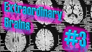 CreutzfeldtJakob Disease Case A Brain Attacked By Abnormal Proteins  Extraordinary Brains 3 [upl. by Tsirhc415]