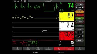 Ventricular Fibrillation with Defibrillation [upl. by Lehcor799]