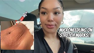 Microneedling on Stretch Marks  Vlog pt 1 [upl. by Sokim]