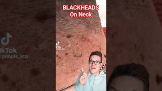 Crazy BLACKHEAD REMOVAL FROM NECK  Perfection shorts [upl. by Silberman]