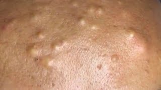 How To Remove Blackheads And Whiteheads On Face Easy 122 ✦ Dr Laelia ✦ [upl. by Boyer47]