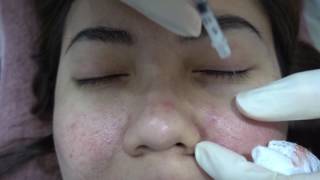 Acne Steroid Injection  Dr Ho Rui Ming Singapore [upl. by Kippie]