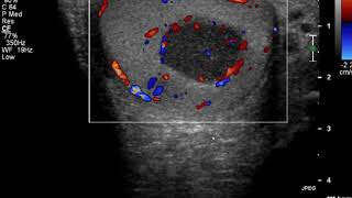 Ultrasound clues that indicate testicular lymphoma [upl. by Yraillih439]