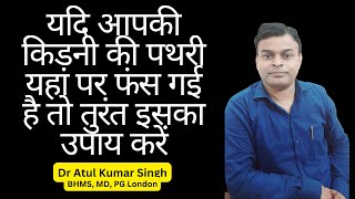 यदि आपकी किडनी स्टोन यूरेटर में फस गई है तो तुरंत इसका इलाज शुरू करें अन्यथा किडनी खराब हो जाएगी [upl. by Ynnig]